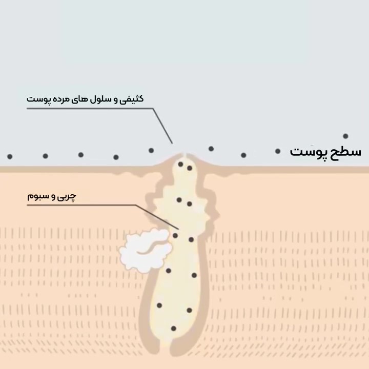کرم ضد جوش آکدین
