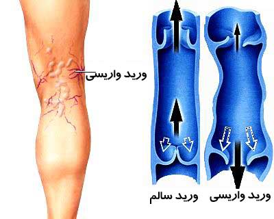 علل ایجاد واریس