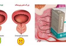 Benign prostatic hyperplasia