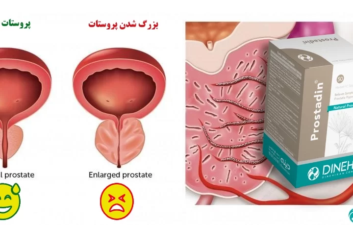Benign prostatic hyperplasia