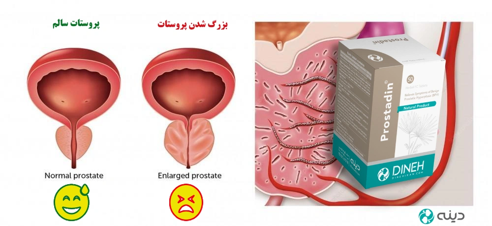 Benign prostatic hyperplasia