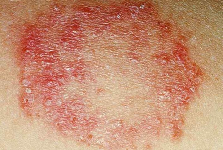 پماد هیدرو کورتیزون برای قارچ پوستی