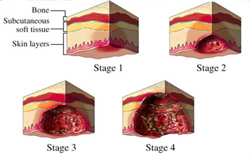انواع زخم بستر و درمان زخم بستر