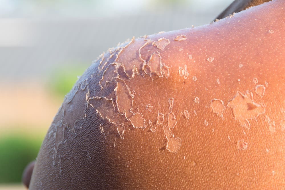 پوست پوست شدن بر اثر آفتاب سوختگی و عوارض آفتاب سوختگی