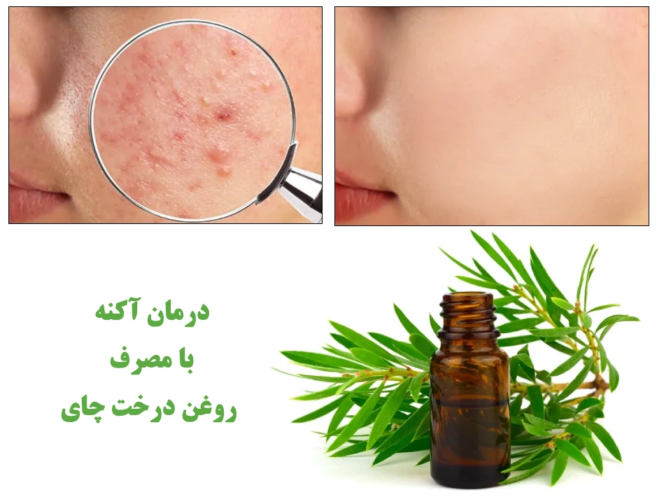 خواص ضد آکنه روغن درخت چای