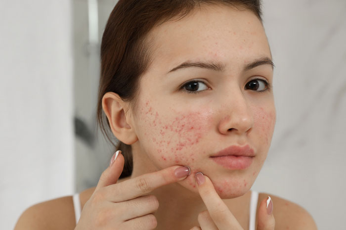آکنه صورت / بهترین قرص های ضد جوش