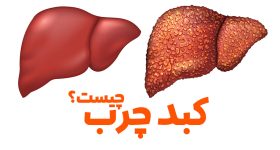 کبد چرب چیست؟