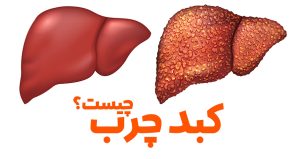 کبد چرب چیست؟