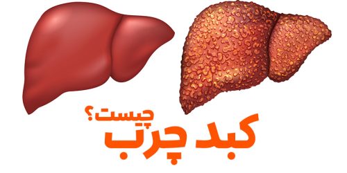 کبد چرب چیست؟