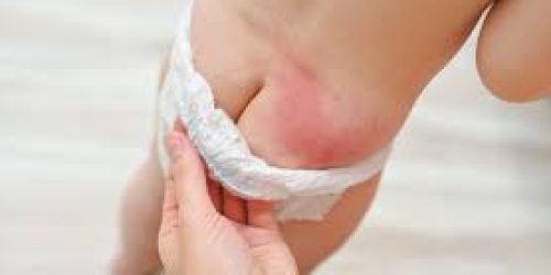 چگونه از ادرار سوختگی نوزاد توسط پوشک جلوگیری کنیم