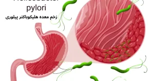 علائم عفونت هلیکوباکتر پیلوری