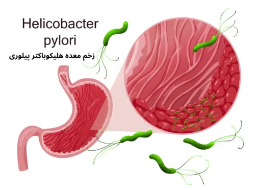 علائم عفونت هلیکوباکتر پیلوری