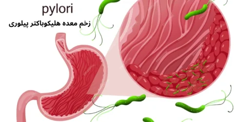 علائم عفونت هلیکوباکتر پیلوری