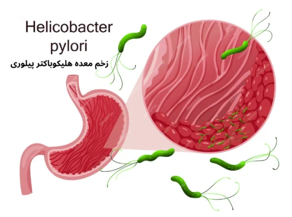 علائم عفونت هلیکوباکتر پیلوری