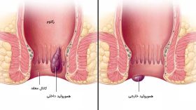 بواسیر یا هموروئید