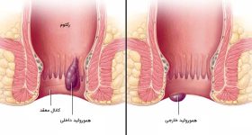 بواسیر یا هموروئید