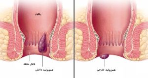 بواسیر یا هموروئید