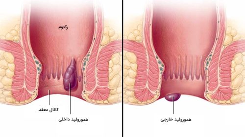 بواسیر یا هموروئید