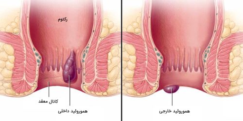 بواسیر یا هموروئید