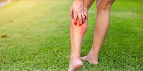 بهترین پماد برای درمان نیش حشرات