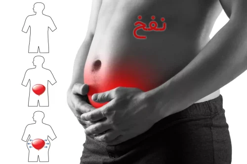 نفخ یا دل درد همراه با باد شکم چیست