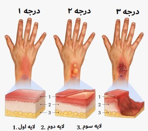 درمان انواع سوختگی با بهترین پماد سوختگی کالاندولا