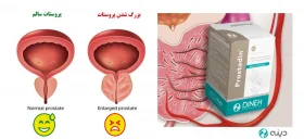 Benign prostatic hyperplasia