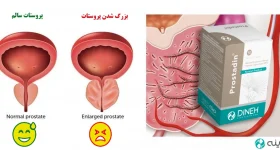 Benign prostatic hyperplasia