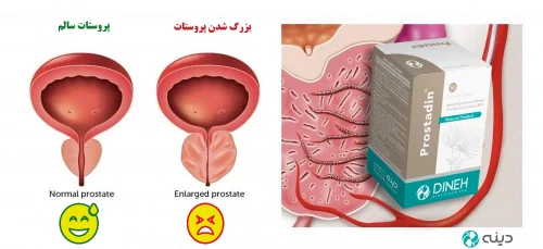 Benign prostatic hyperplasia