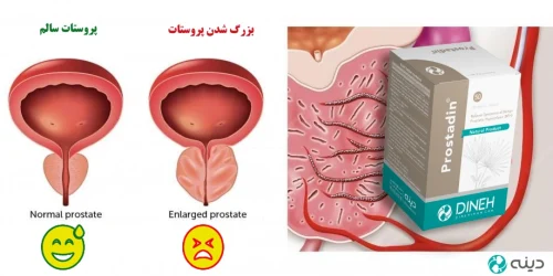 Benign prostatic hyperplasia