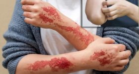 حساسیت پوستی چیست و روشهای درمان آن کدامند؟